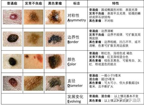 胸部長黑痣|身上三部位長「黑痣」竟是潛在「黑色素癌」？兩種黑痣外觀最危險